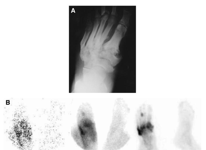 Osteomiyelit/Charcot artropatisi(2) Üç fazlı kemik