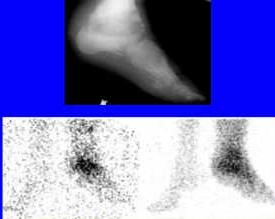 İşaretli lökosit/kemik iliği sintigrafisi Lökosit Kemik