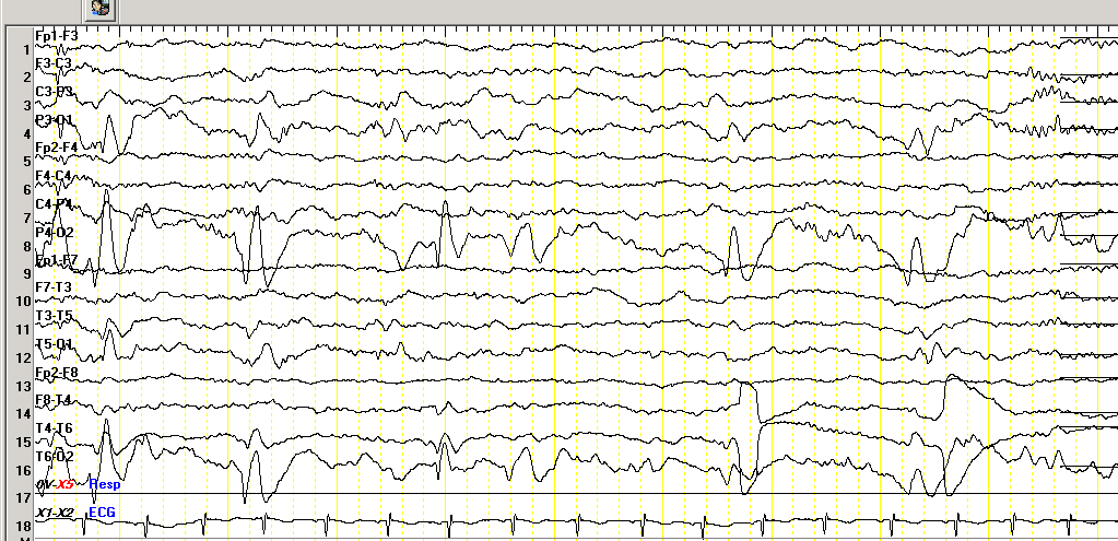 Fokal Epileptiform