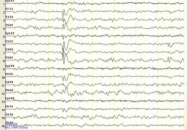 Fokal Epileptiform Aktivite: