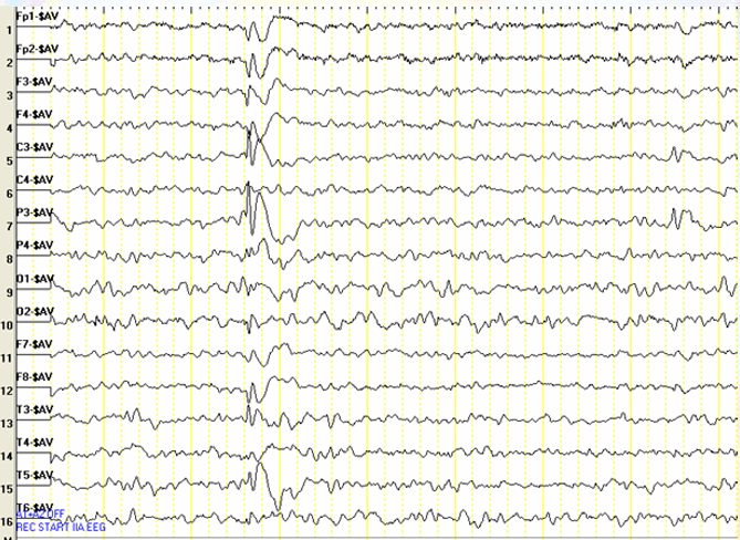 Fokal Epileptiform Aktivite: İnteriktal