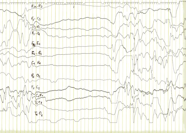 Supresyon Burst Hipsaritmi EEG: Supresyon-burst (SB) Burst: 2-6 sn,