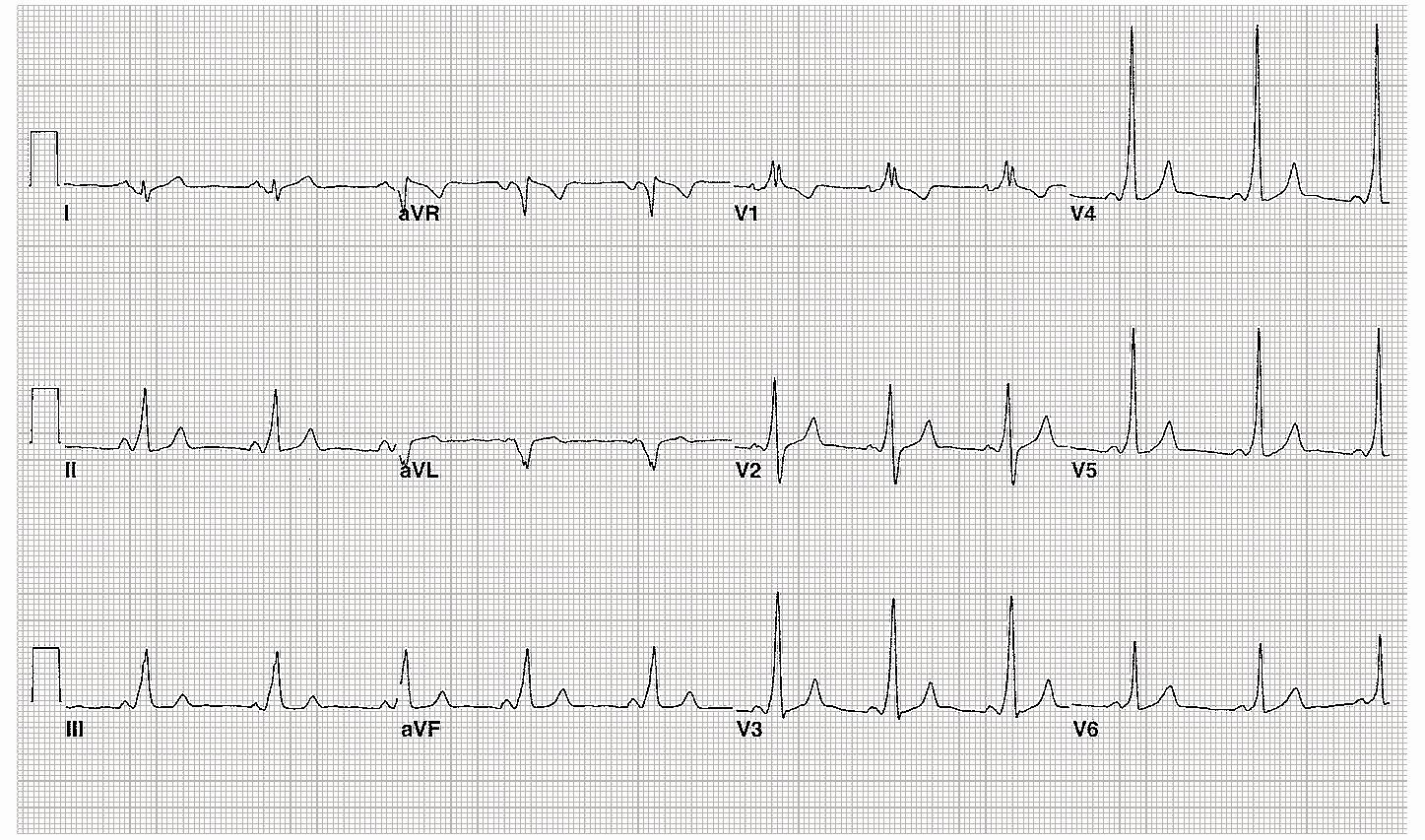 PR interval anormallikleri PR interval uzaması (birinci derece A-V blok): A-V nod düzeyinde, iletimdeki anormal gecikme a. Miyokardit; romatizmal, viral veya difteri ile ilişkili b.