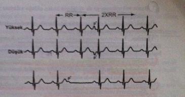 ATRİYAL ERKEN VURU-2 Bazen bir atriyal vuruyu