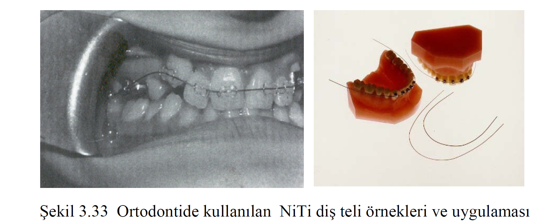 Ni-Ti Şekil Bellekli Alaşımların Uygulamaları Diş telleri çarpık dişleri kuvvet uygulayarak uygun aralığa yerleştirmekte kullanılır.