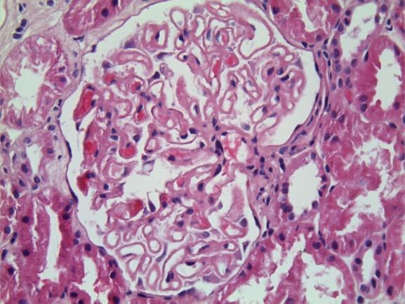 Lupus Nefriti Patogenez Lupus Nefriti immün kompleks aracılı renal hasar ve sekeli Glomerüler hasar esas!