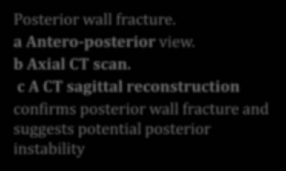 Posterior wall fracture.