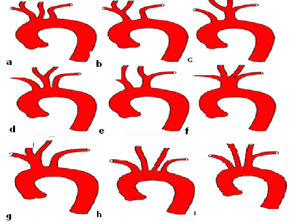 Arkus aorta, innominate arterden ligamentum arteriozuma kadar olan kısımdır.