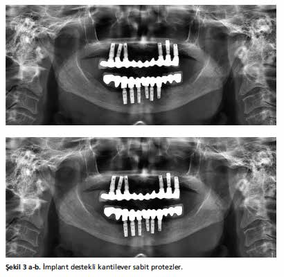 35 BİLİMSEL ÇALIŞMALAR disklüzyon mevcutken, posterior dişler bir dişe bir diş ve tüber - kül fossa ilişkisi içindedir.