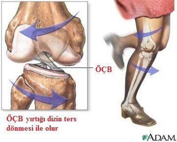 Ön çapraz bağ yaralanmaları kendi içinde ciddiyetine göre derecelendirilir; Evre 1 yırtıklar; hafif düzeyde gerilme şeklinde olup dizde ağrı vardır fakat stabilite kaybı yoktur.