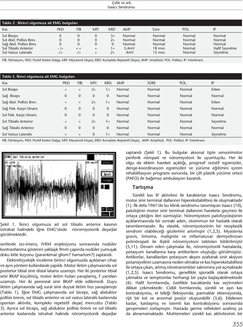 Sol Tibialis Anterior Sol Vastus Lateralis - /+ -/+ + + -/+ + + 3+ 2+ 1+ 2+ 5,4mV 4mV 18 msn 15 msn FİB: Fibrilasyon, PKD: Pozitif Keskin Dalga, MİY: Miyotonik Deşarj, KRD: Kompleks Repetetif Deşarj,