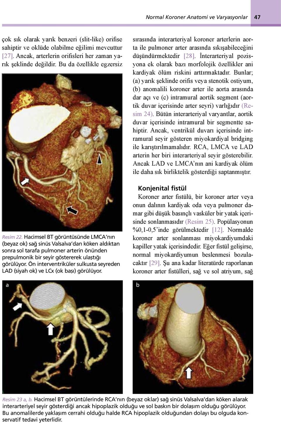 Hacimsel BT görüntüsünde LMCA nın (beyaz ok) sağ sinüs Valsalva dan köken aldıktan sonra sol tarafa pulmoner arterin önünden prepulmonik bir seyir göstererek ulaştığı görülüyor.