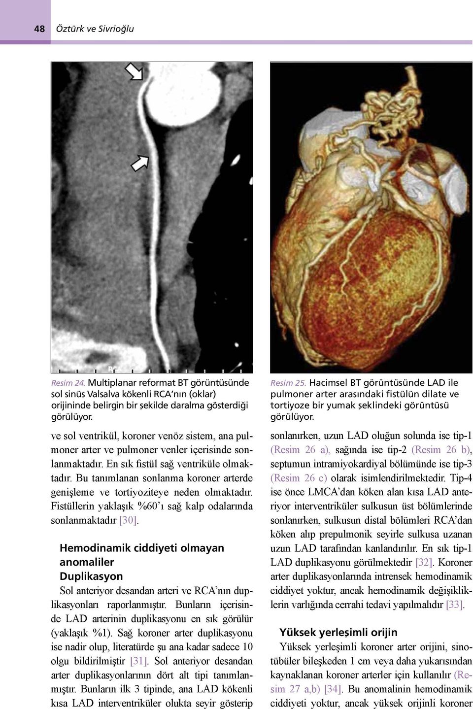 Bu tanımlanan sonlanma koroner arterde genişleme ve tortiyoziteye neden olmaktadır. Fistüllerin yaklaşık %60 ı sağ kalp odalarında sonlanmaktadır [30].