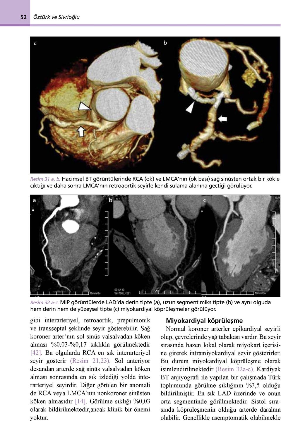 MIP görüntülerde LAD da derin tipte (a), uzun segment miks tipte (b) ve aynı olguda hem derin hem de yüzeysel tipte (c) miyokardiyal köprüleşmeler görülüyor.