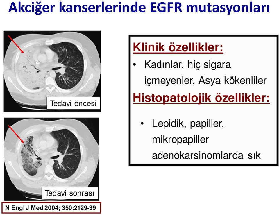 Histopatolojik özellikler: Lepidik, papiller, mikropapiller