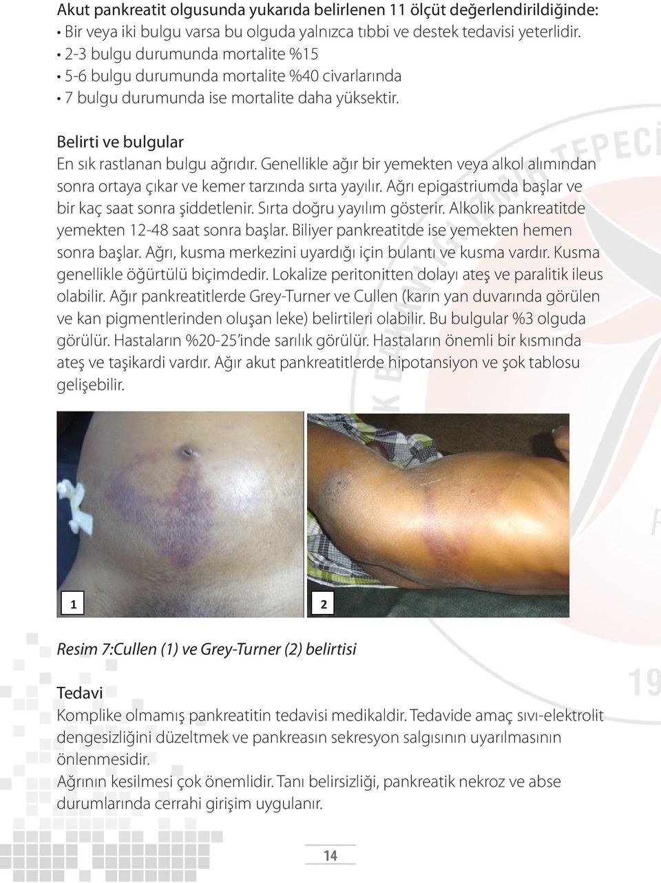 Genellikle ağır bir yemekten veya alkol alımından sonra ortaya çıkar ve kemer tarzında sırta yayılır. Ağrı epigastriumda başlar ve bir kaç saat sonra şiddetlenir. Sırta doğru yayılım gösterir.