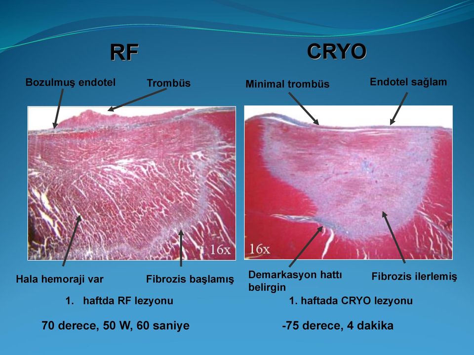 hattı Fibrozis ilerlemiş belirgin 1. haftda RF lezyonu 1.