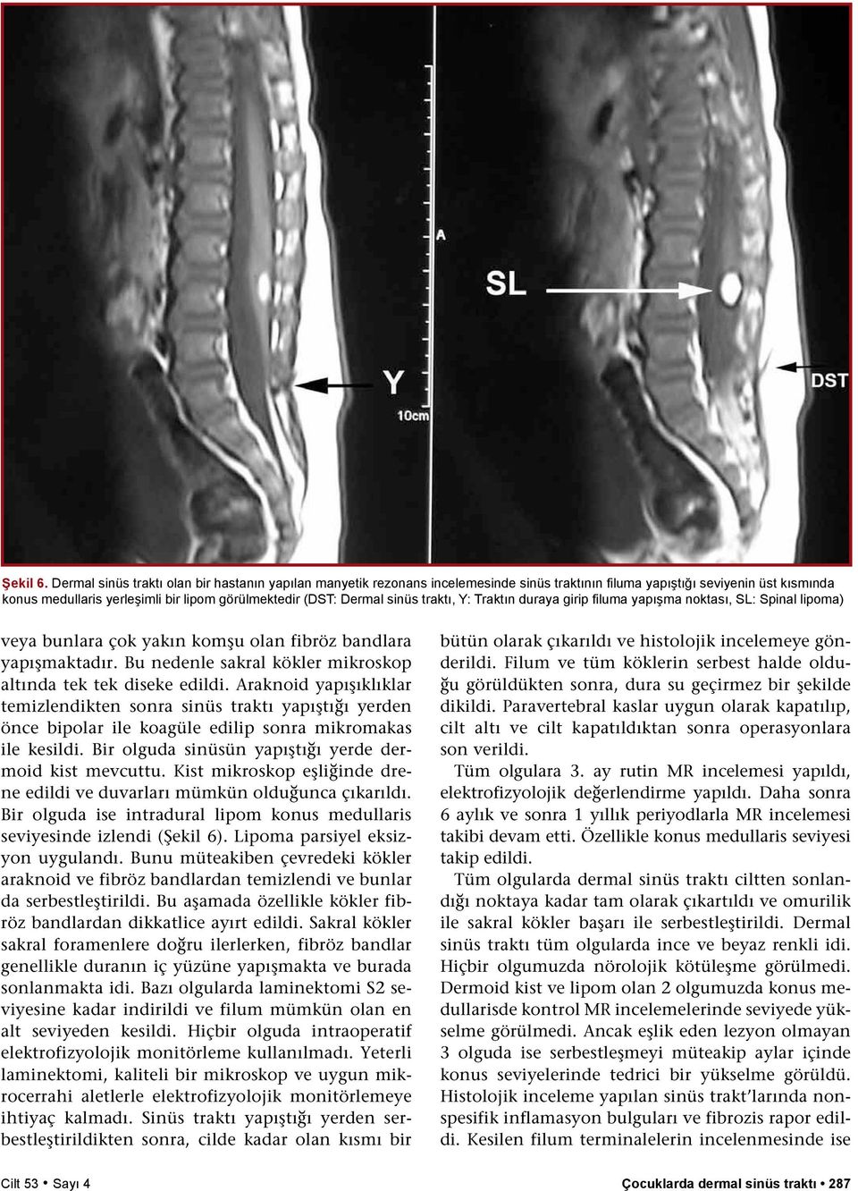 sinüs traktı, Y: Traktın duraya girip filuma yapışma noktası, SL: Spinal lipoma) veya bunlara çok yakın komşu olan fibröz bandlara yapışmaktadır.