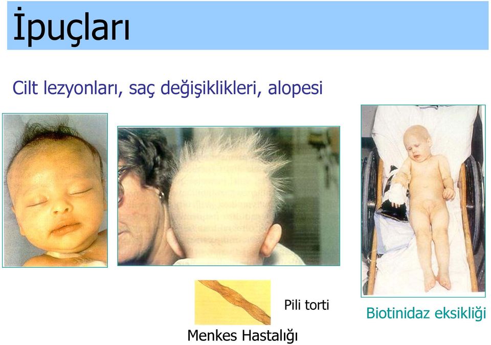 alopesi Menkes Hastalığı