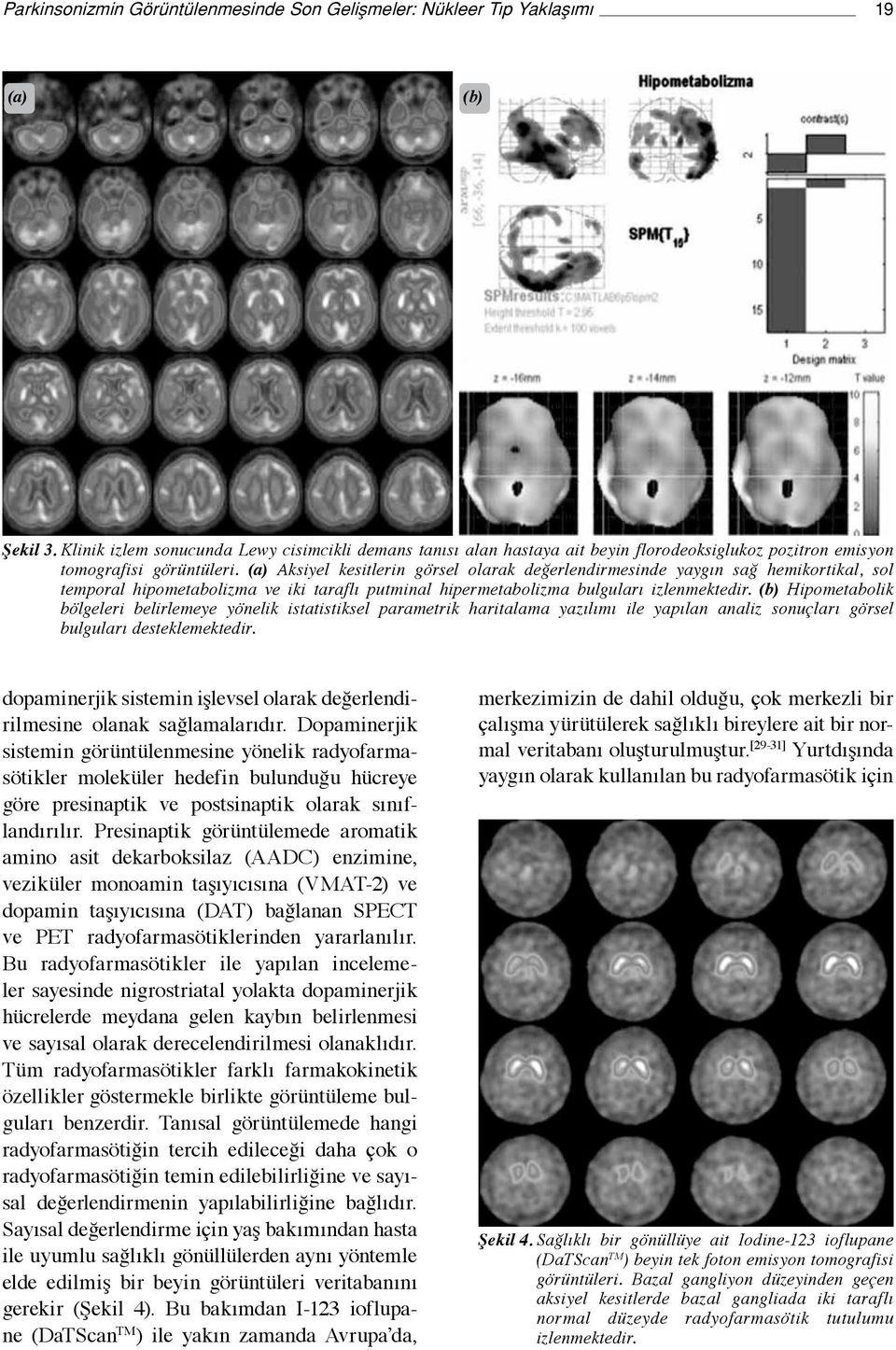 (a) Aksiyel kesitlerin görsel olarak değerlendirmesinde yaygın sağ hemikortikal, sol temporal hipometabolizma ve iki taraflı putminal hipermetabolizma bulguları izlenmektedir.