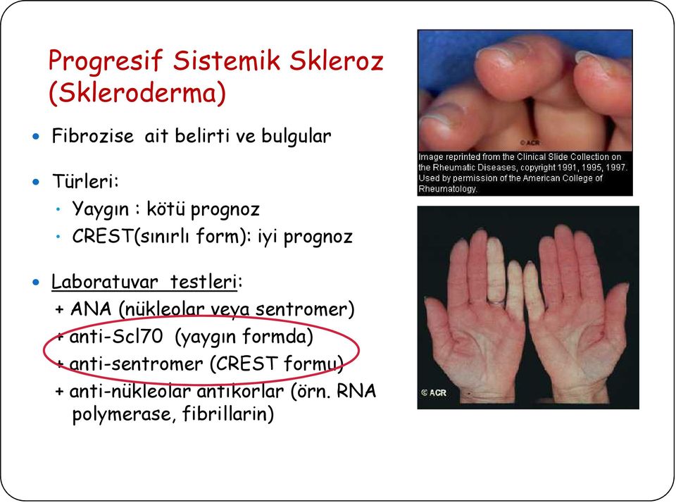 testleri: + ANA (nükleolar veya sentromer) + anti-scl70 (yaygın formda) +