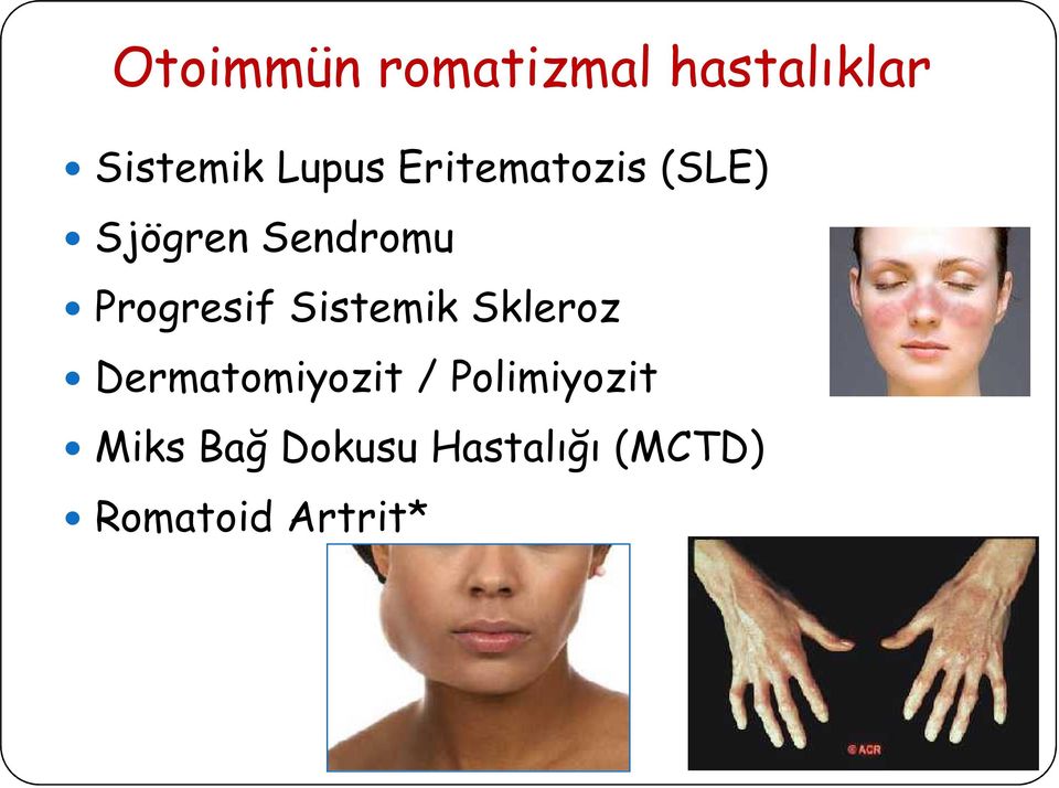 Sistemik Skleroz Dermatomiyozit / Polimiyozit