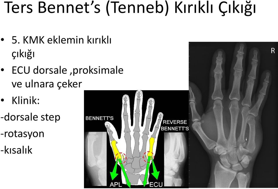 KMK eklemin kırıklı çıkığı ECU