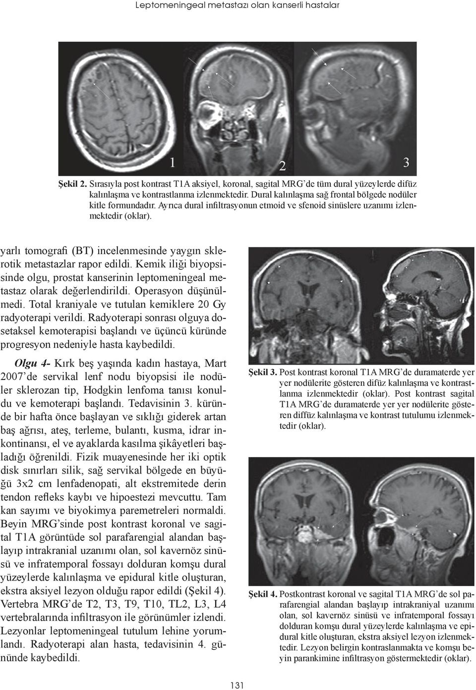 yarlı tomografi (BT) incelenmesinde yaygın sklerotik metastazlar rapor edildi. Kemik iliği biyopsisinde olgu, prostat kanserinin leptomeningeal metastaz olarak değerlendirildi. Operasyon düşünülmedi.