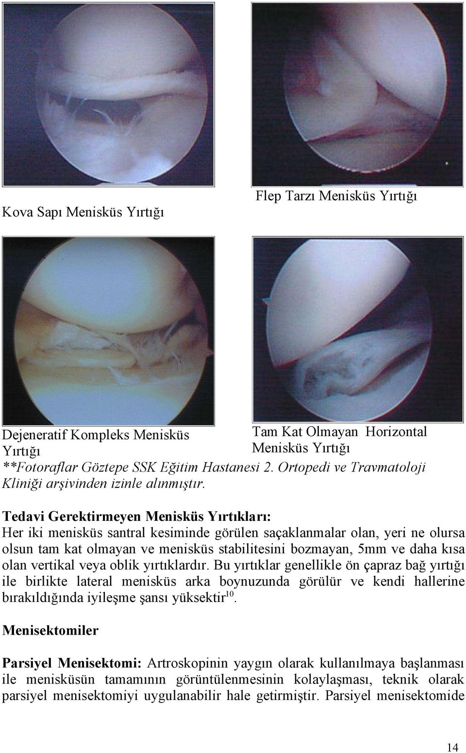 Tedavi Gerektirmeyen Menisküs Yırtıkları: Her iki menisküs santral kesiminde görülen saçaklanmalar olan, yeri ne olursa olsun tam kat olmayan ve menisküs stabilitesini bozmayan, 5mm ve daha kısa olan