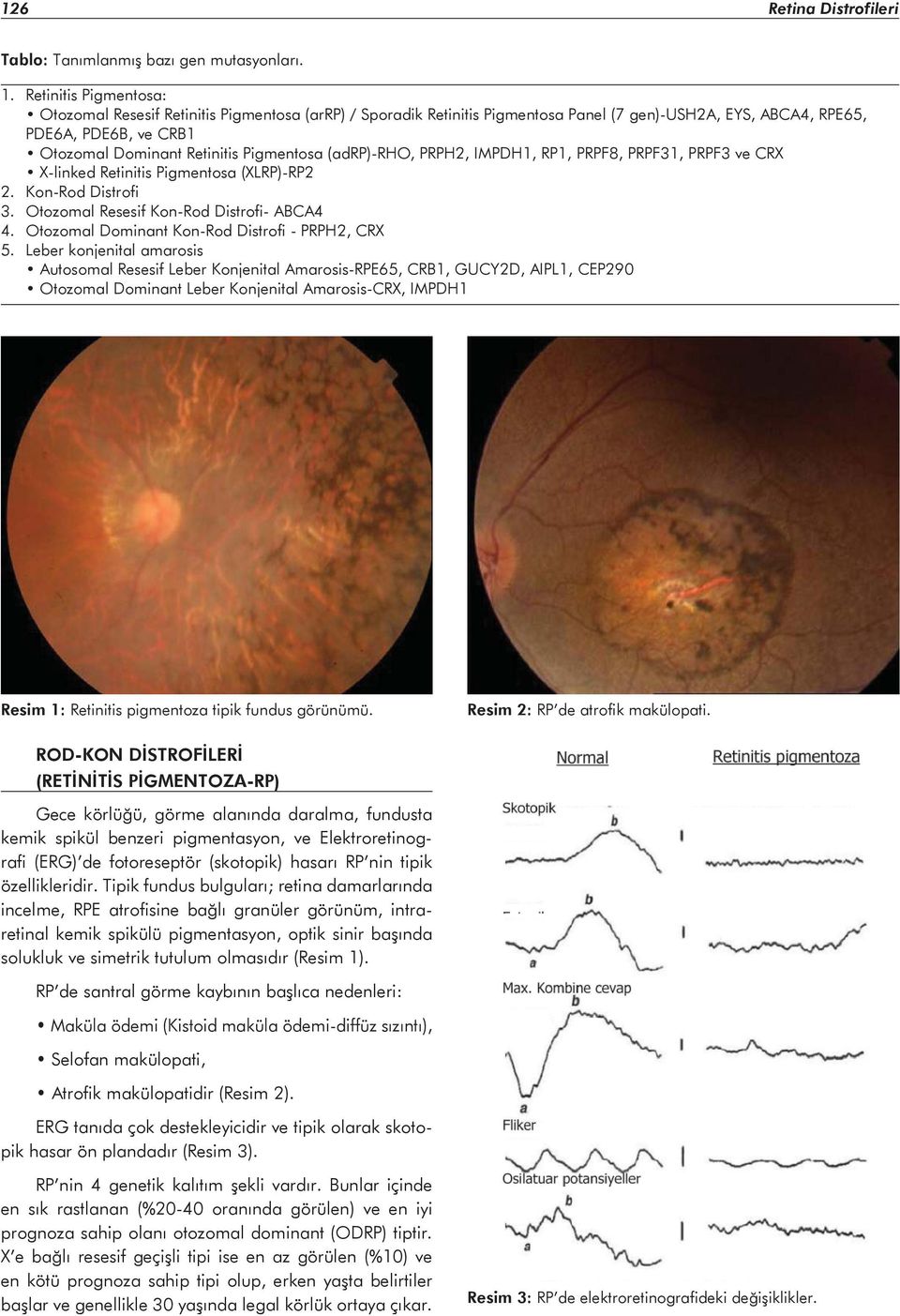 (adrp)-rho, PRPH2, IMPDH1, RP1, PRPF8, PRPF31, PRPF3 ve CRX X-linked Retinitis Pigmentosa (XLRP)-RP2 2. Kon-Rod Distrofi 3. Otozomal Resesif Kon-Rod Distrofi- ABCA4 4.