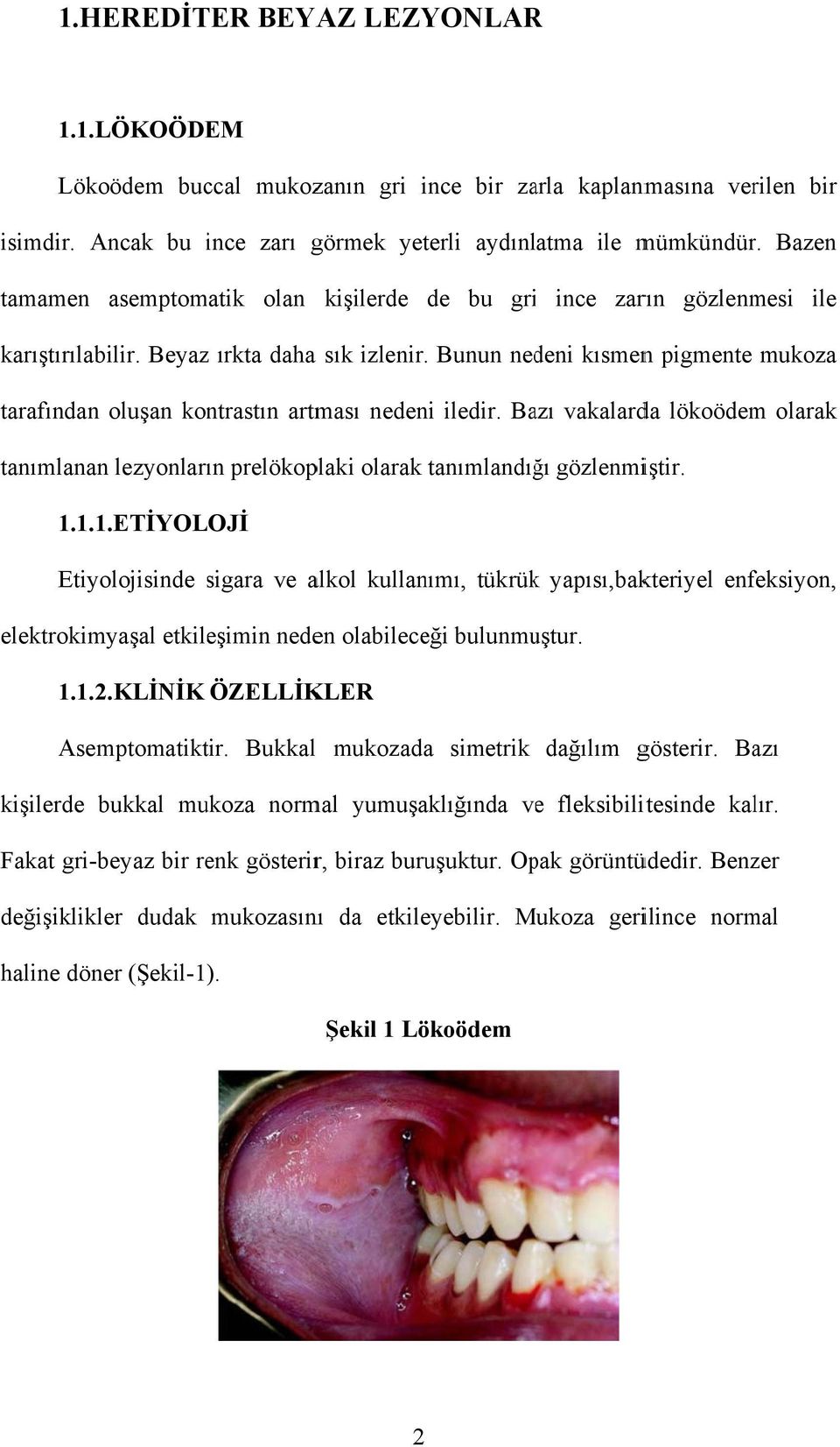 Bunun nedeni kısmenn pigmente mukoza tarafındann oluşan kontrastın artması nedeni iledir. Bazı vakalarda lökoödem olarak tanımlanann lezyonların prelökoplaki olarak tanımlandığı gözlenmiştir. 1.