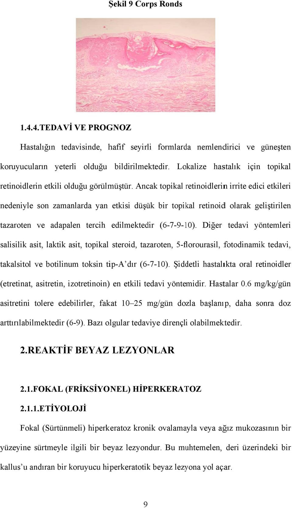 Ancak topikal retinoidlerinr n irrite edici etkileri nedeniyle son zamanlarda yan etkisi düşük bir topikal retinoidd olarak geliştirilen tazaroten ve adapalen tercih edilmektedir (6-7-9-10).