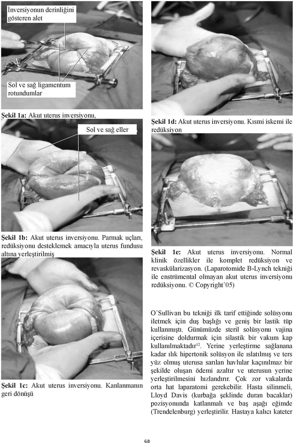 Normal klinik özellikler ile komplet redüksiyon ve revaskülarizasyon. (Laparotomide B-Lynch tekniği ile enstrümental olmayan akut uterus inversiyonu redüksiyonu.