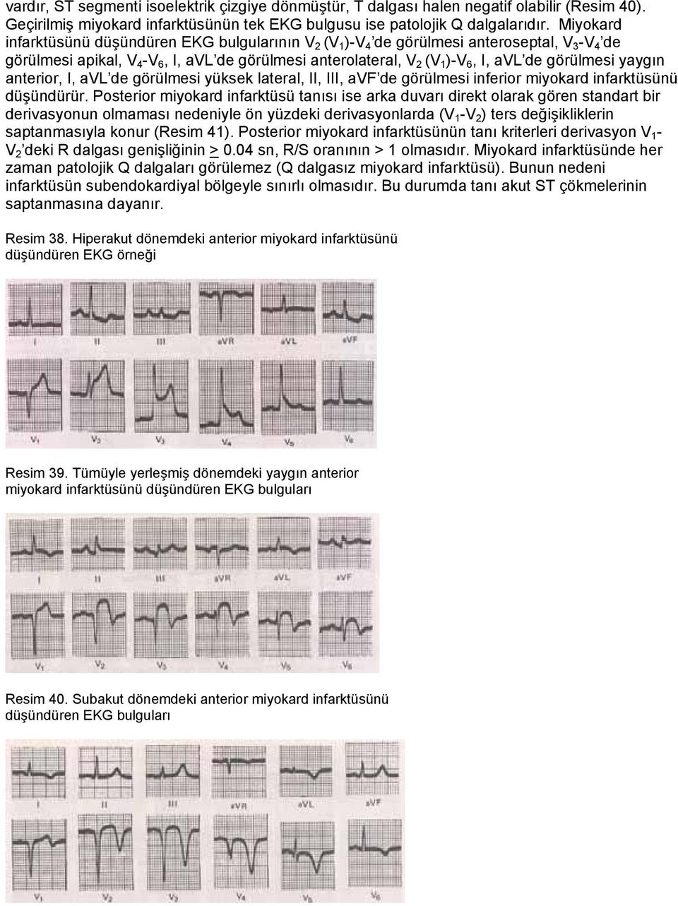 görülmesi yaygın anterior, I, avl de görülmesi yüksek lateral, II, III, avf de görülmesi inferior miyokard infarktüsünü düşündürür.