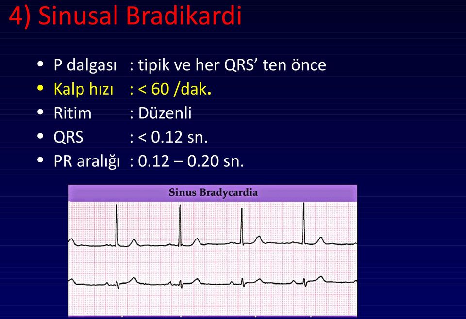 tipik ve her QRS ten önce : < 60