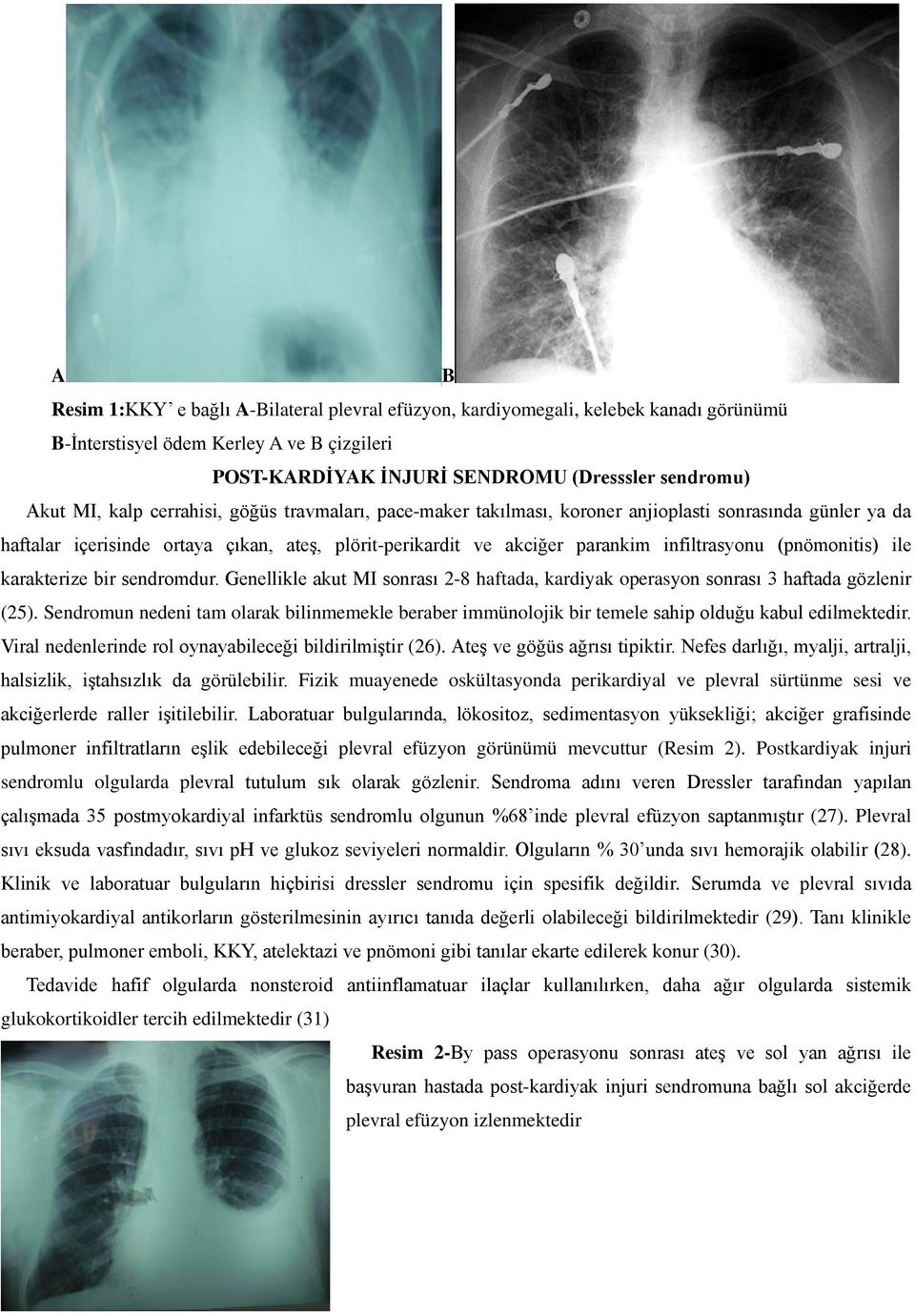 (pnömonitis) ile karakterize bir sendromdur. Genellikle akut MI sonrası 2-8 haftada, kardiyak operasyon sonrası 3 haftada gözlenir (25).