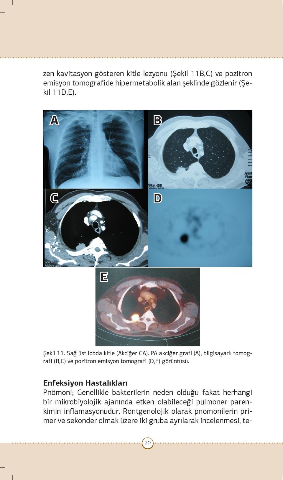 PA akciğer grafi (A), bilgisayarlı tomografi (B,C) ve pozitron emisyon tomografi (D,E) görüntüsü.