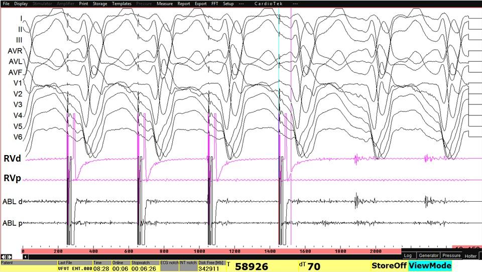 PCL 400 msn RCL