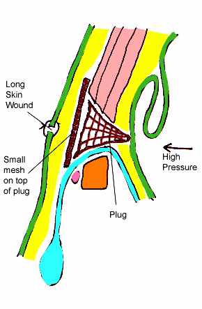 Şekil -13: Lictenstein yöntemi ile fıtık onarımı(1) B- Posterior Yaklaşım Preperitoneal onarım (Đliopubik trakt onarımı) Komplike ve nüks hernilerde yararlıdır.