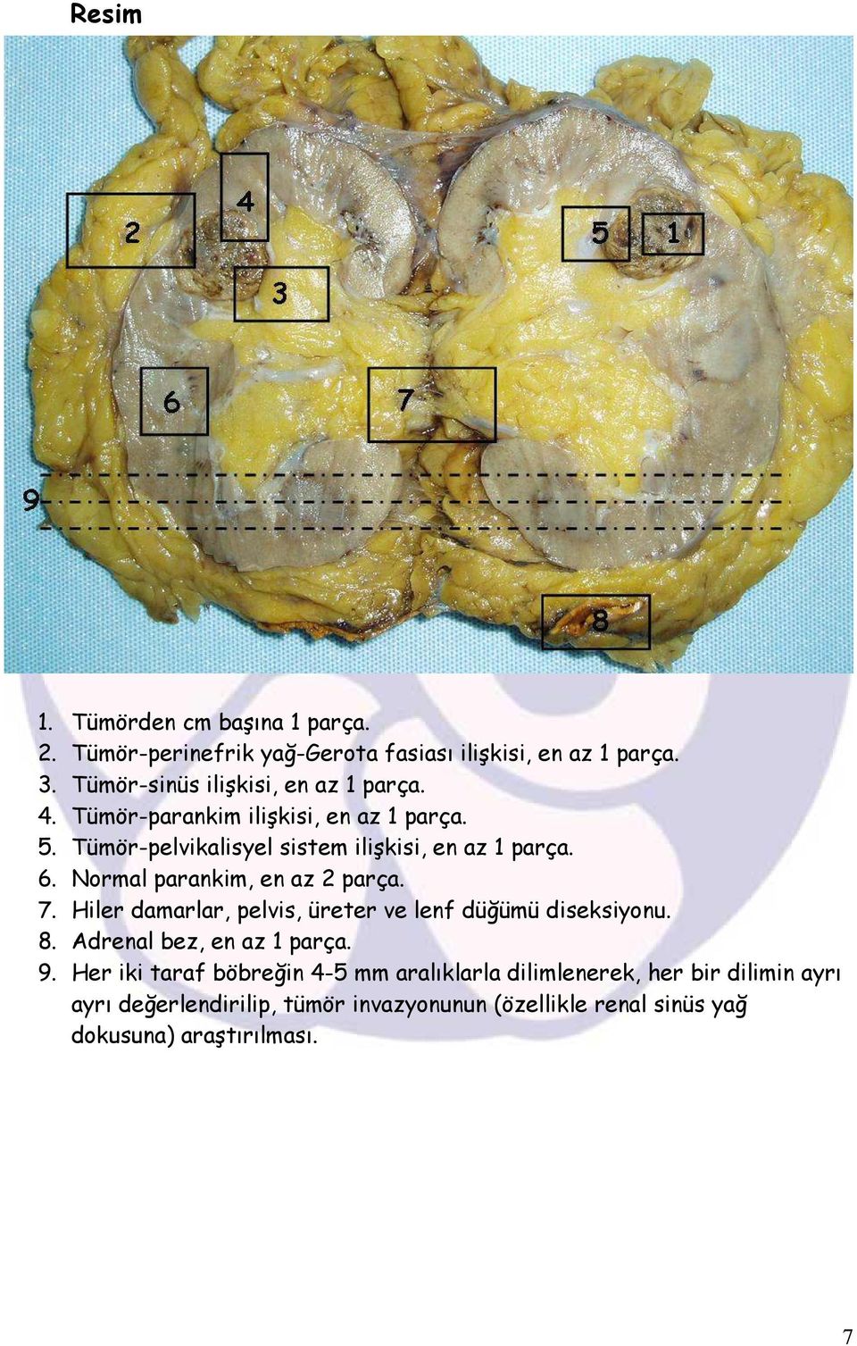 6. Normal parankim, en az 2 parça. 7. Hiler damarlar, pelvis, üreter ve lenf düğümü diseksiyonu. 8. Adrenal bez, en az 1 parça. 9.