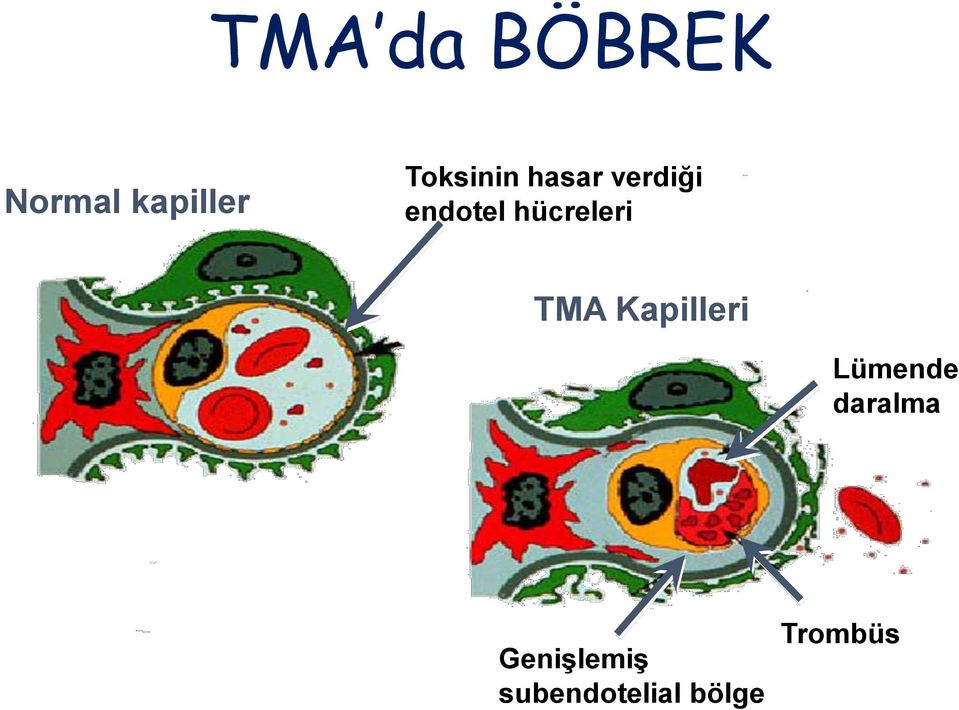 hücreleri TMA Kapilleri Lümende