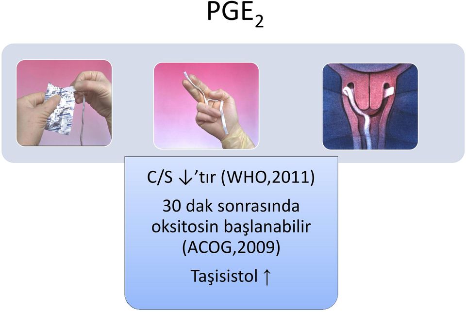 başlanabilir (ACOG,2009) Uterin