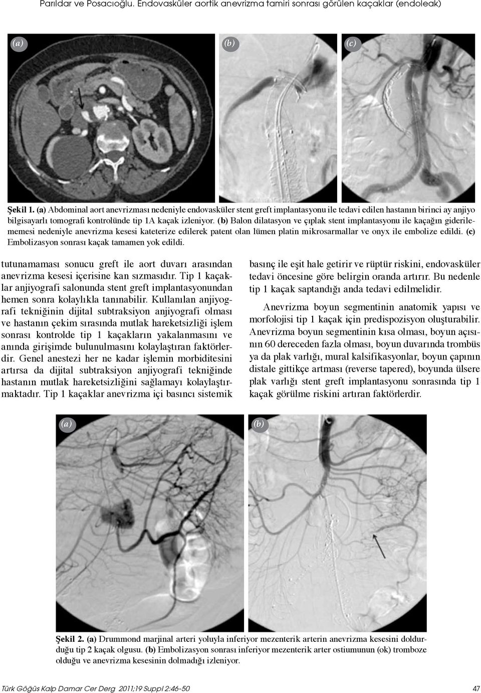 (b) Balon dilatasyon ve çıplak stent implantasyonu ile kaçağın giderilememesi nedeniyle anevrizma kesesi kateterize edilerek patent olan lümen platin mikrosarmallar ve onyx ile embolize edildi.