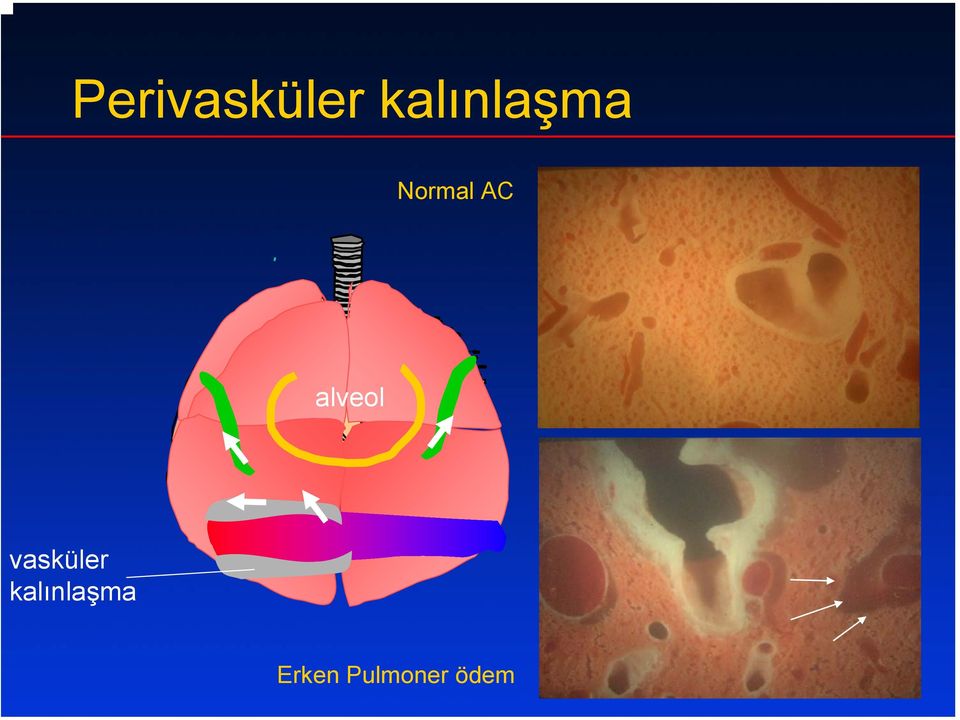 AC alveol vasküler