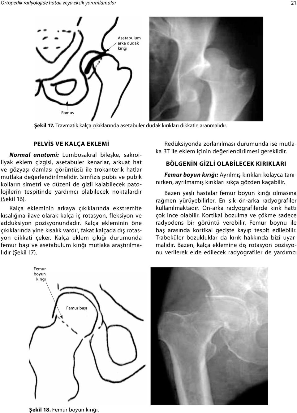 Simfizis pubis ve pubik kolların simetri ve düzeni de gizli kalabilecek patolojilerin tespitinde yardımcı olabilecek noktalardır (Şekil 16).