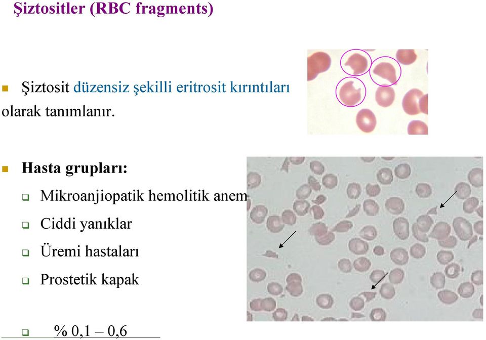 Hasta grupları: Mikroanjiopatik hemolitik anemi