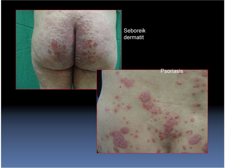 Psoriasis