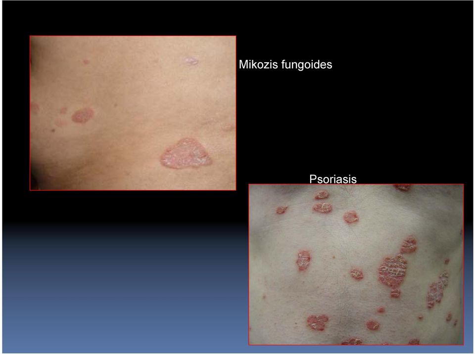 Psoriasis