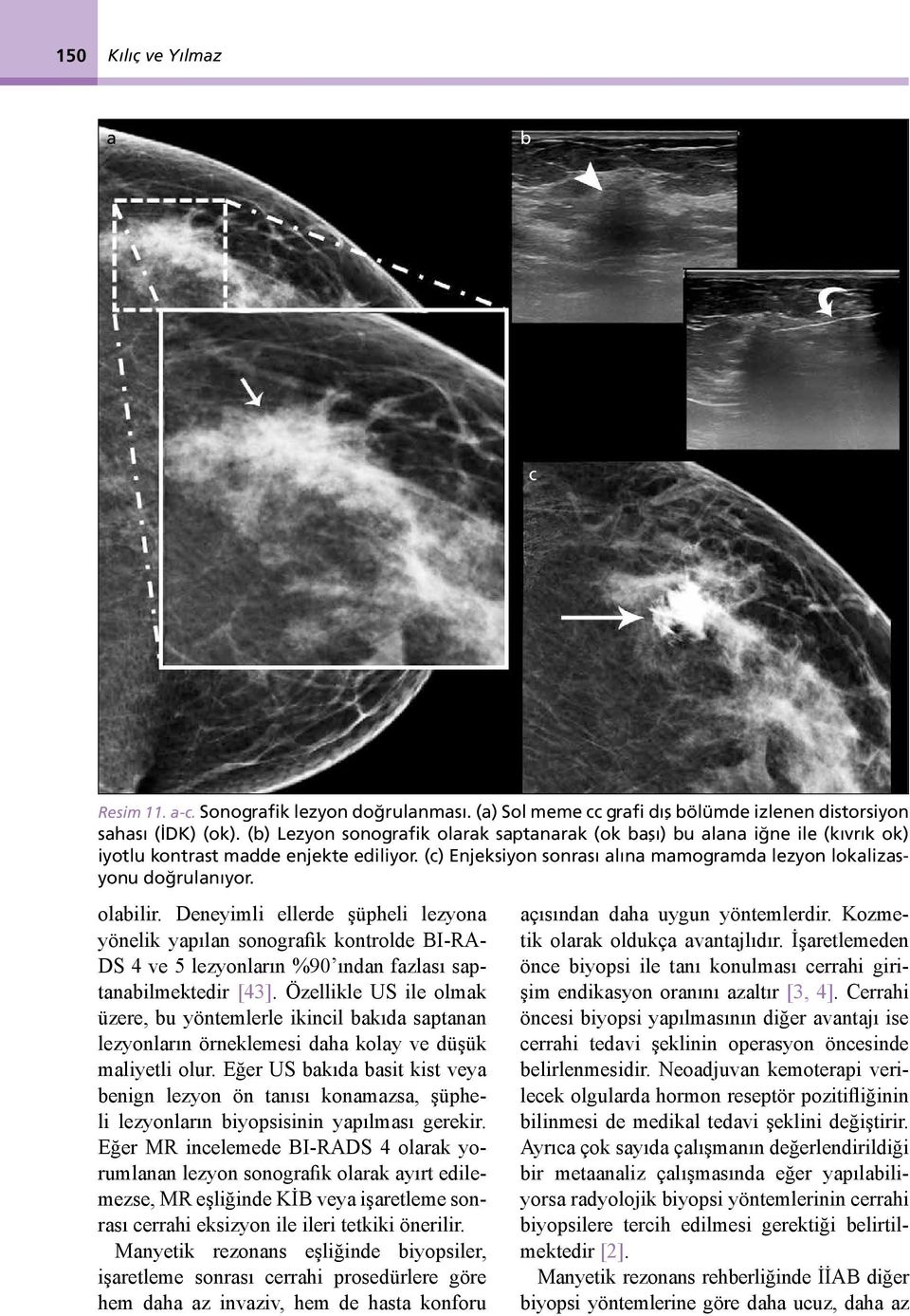 olabilir. Deneyimli ellerde şüpheli lezyona yönelik yapılan sonografik kontrolde BI-RA- DS 4 ve 5 lezyonların %90 ından fazlası saptanabilmektedir [43].