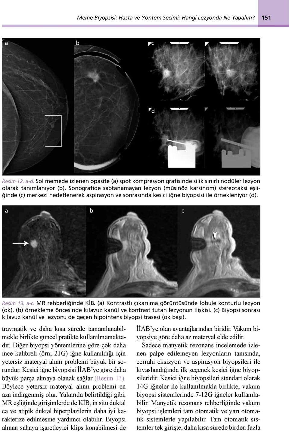 Sonografide saptanamayan lezyon (müsinöz karsinom) stereotaksi eşliğinde (c) merkezi hedeflenerek aspirasyon ve sonrasında kesici iğne biyopsisi ile örnekleniyor (d). a b c Resim 13. a-c.